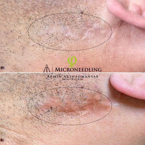 Microneedling by Mandy Charlish