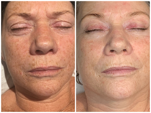 Microneedling by Mandy Charlish