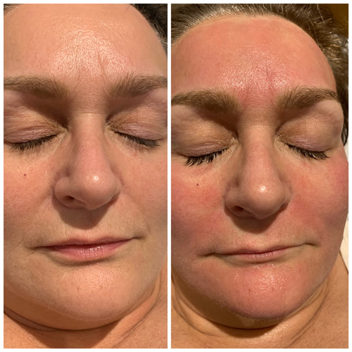 Microneedling by Mandy Charlish