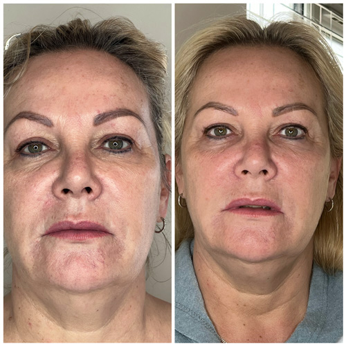 Plasma Skin Tightening by Mandy Charlish