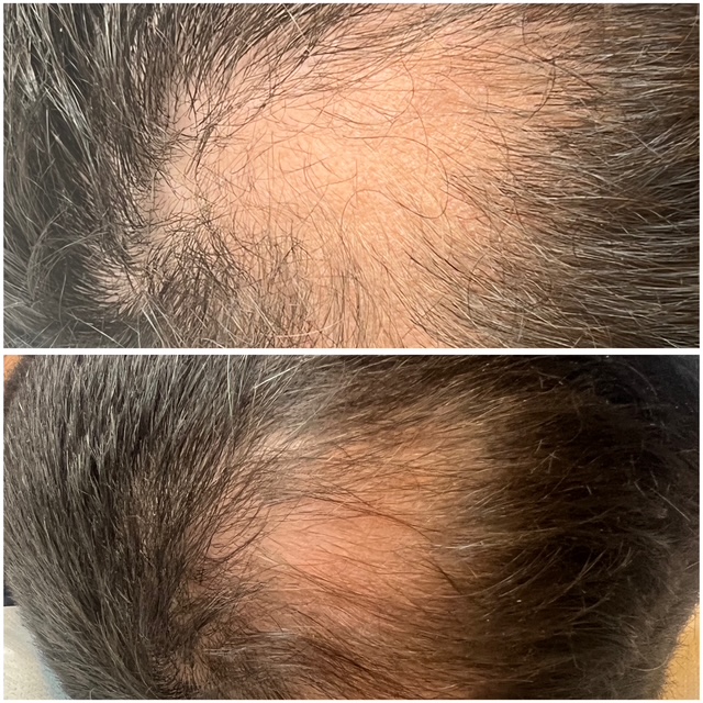 Hair Restoration