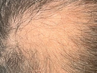 Hair Restoration Before