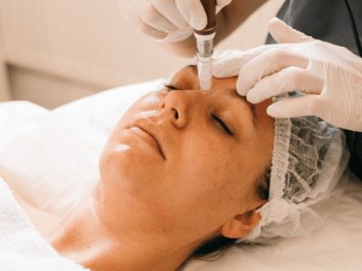 Microneedling 1