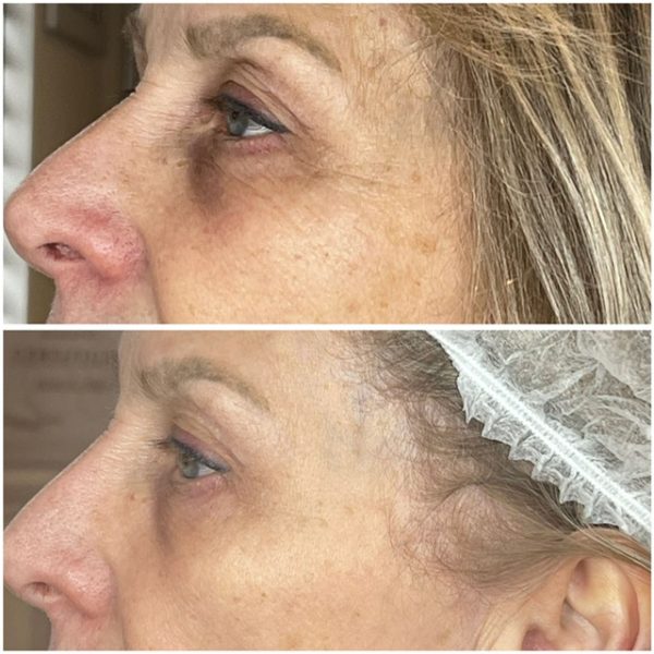 Plasma Before and After