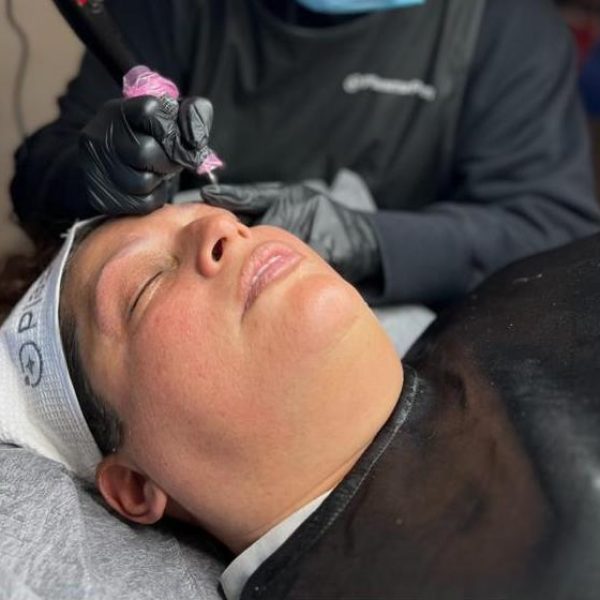 Plasma Pen Treatment 1