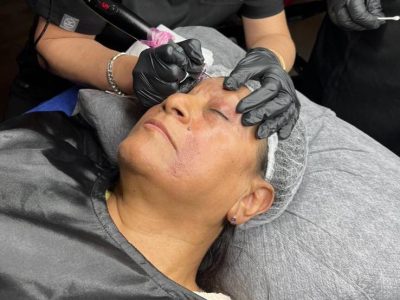 Plasma Pen Treatment 2