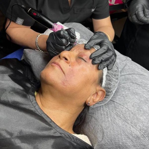 Plasma Pen Treatment 2