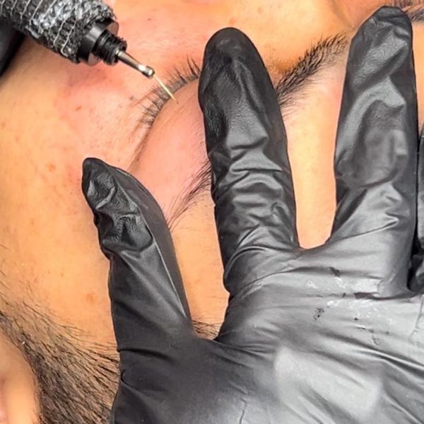 Plasma Pen Treatment 3