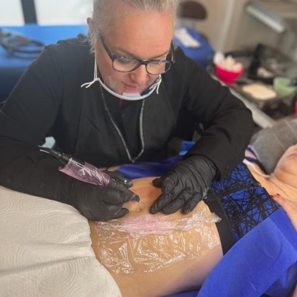 Plasma Pen Treatment 4