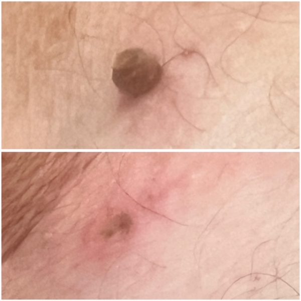 mole removal